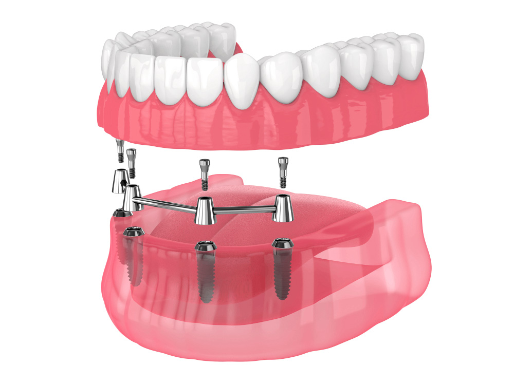 illustration of a full mouth dental implant