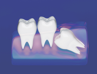 illustration of an impacted wisdom tooth.