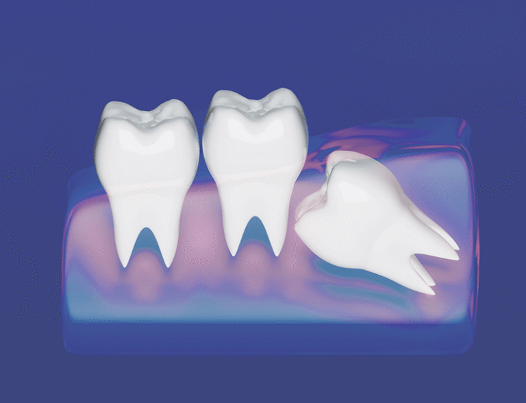 illustration of an impacted wisdom tooth.